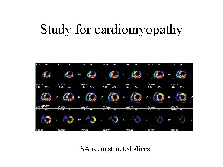 Study for cardiomyopathy SA reconstructed slices 