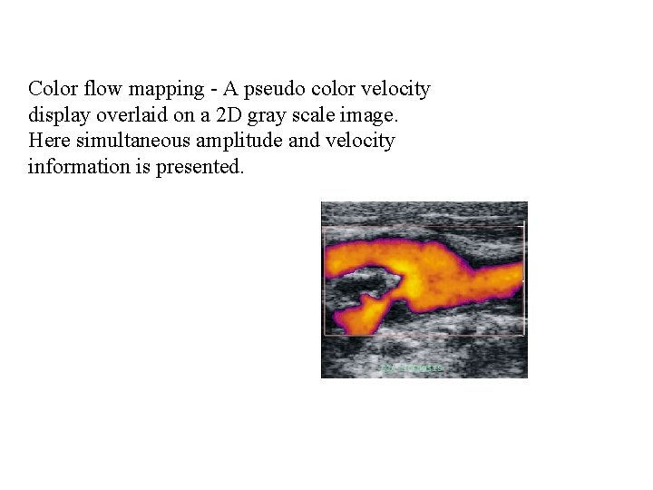 Color flow mapping - A pseudo color velocity display overlaid on a 2 D