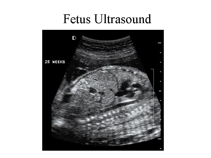 Fetus Ultrasound 