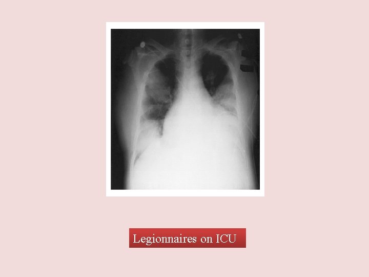 Legionnaires on ICU 