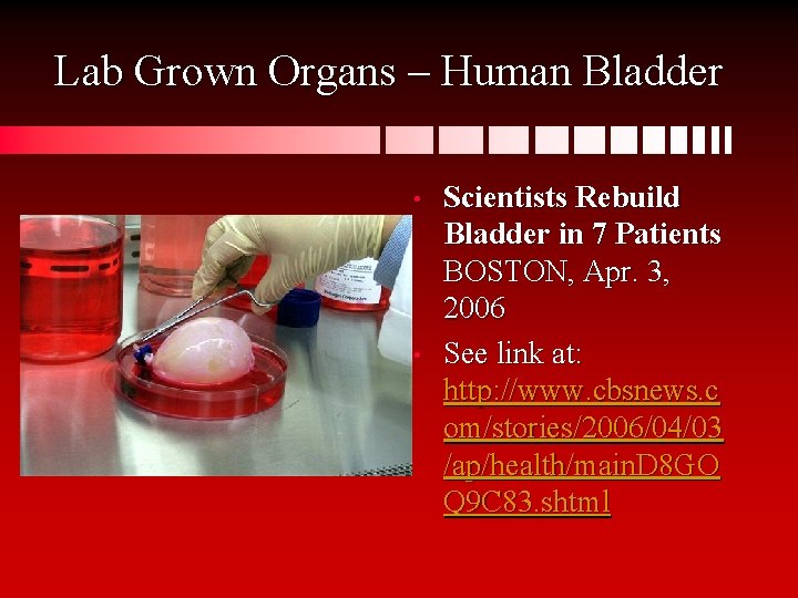 Lab Grown Organs – Human Bladder • • Scientists Rebuild Bladder in 7 Patients