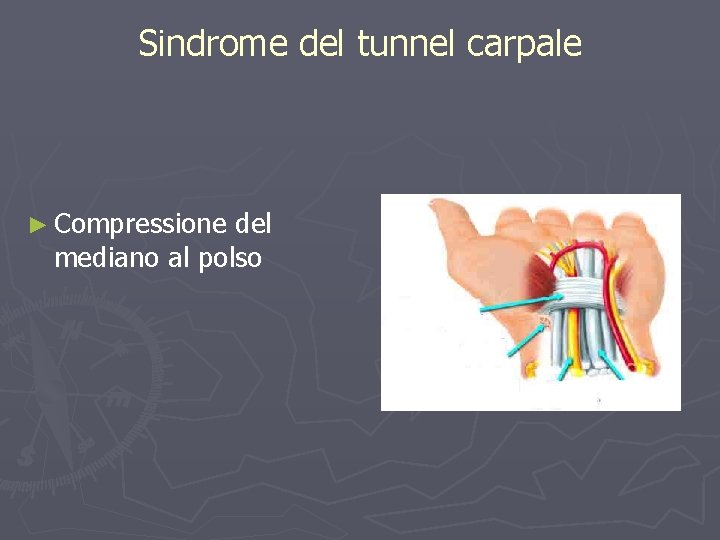 Sindrome del tunnel carpale ► Compressione del mediano al polso 