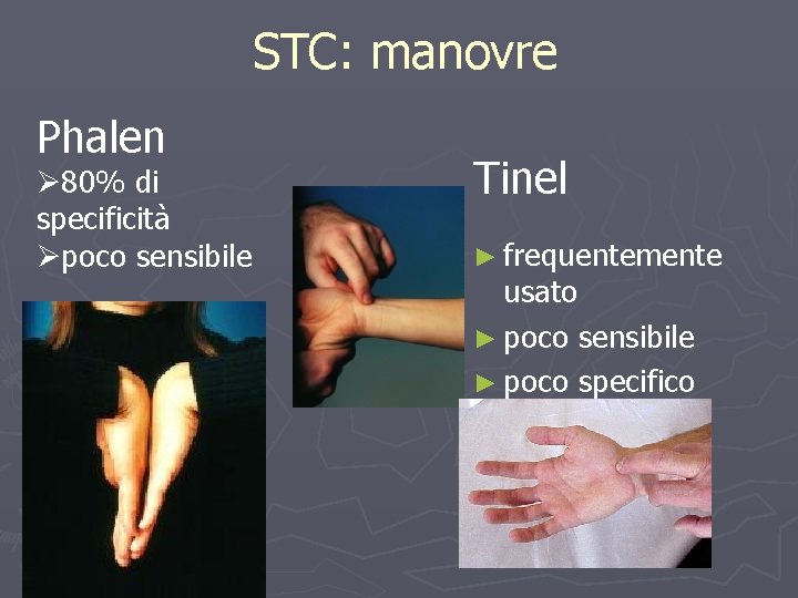 STC: manovre Phalen Ø 80% di specificità Øpoco sensibile Tinel ► frequentemente usato ►