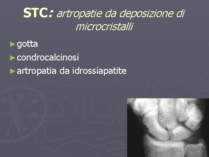 STC: artropatie da deposizione di microcristalli ► gotta ► condrocalcinosi ► artropatia da idrossiapatite