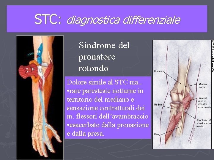 STC: diagnostica differenziale Sindrome del pronatore rotondo Dolore simile al STC ma. . •