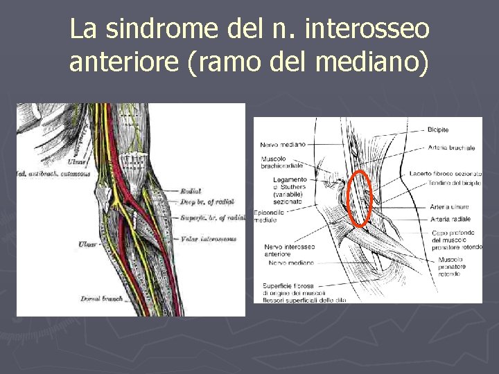 La sindrome del n. interosseo anteriore (ramo del mediano) 