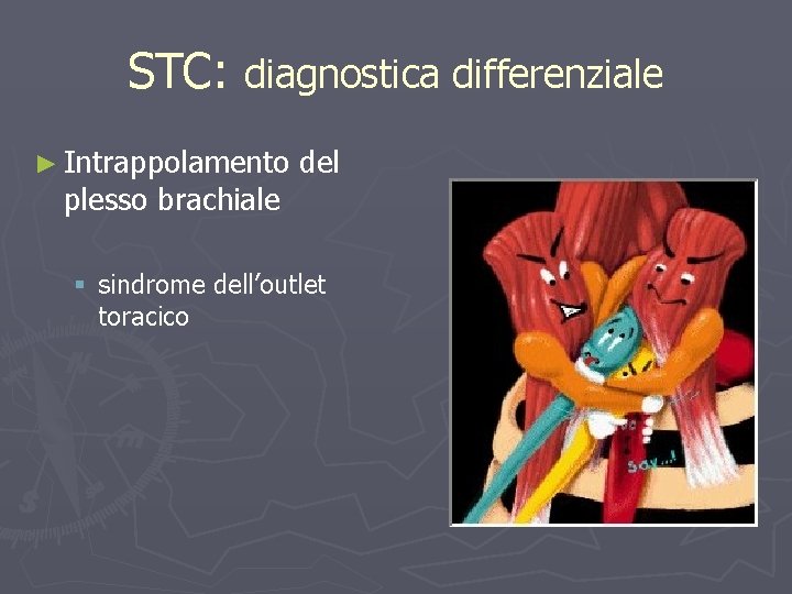 STC: diagnostica differenziale ► Intrappolamento plesso brachiale del § sindrome dell’outlet toracico 