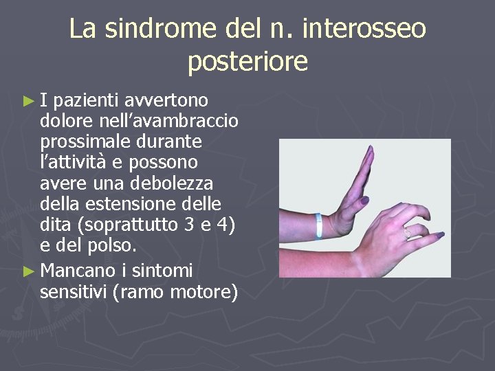 La sindrome del n. interosseo posteriore ►I pazienti avvertono dolore nell’avambraccio prossimale durante l’attività