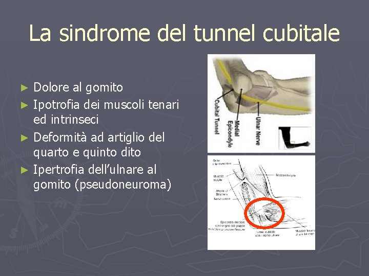 La sindrome del tunnel cubitale Dolore al gomito ► Ipotrofia dei muscoli tenari ed