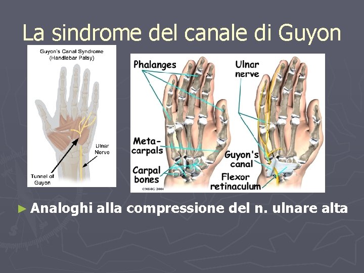 La sindrome del canale di Guyon ► Analoghi alla compressione del n. ulnare alta