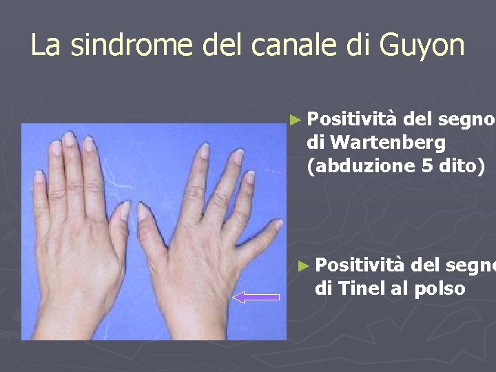 La sindrome del canale di Guyon ► Positività del segno di Wartenberg (abduzione 5