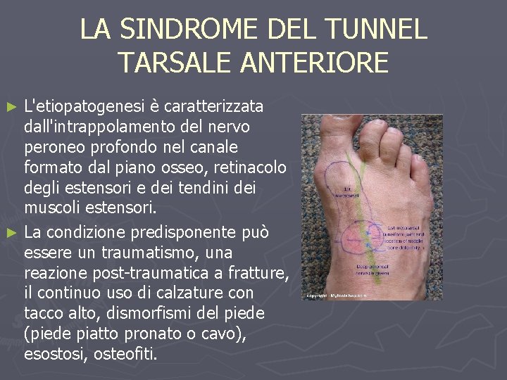 LA SINDROME DEL TUNNEL TARSALE ANTERIORE L'etiopatogenesi è caratterizzata dall'intrappolamento del nervo peroneo profondo