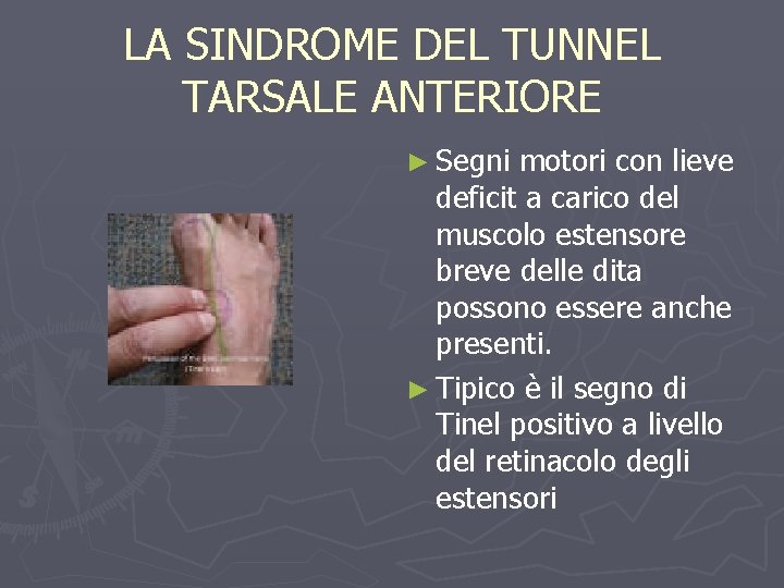 LA SINDROME DEL TUNNEL TARSALE ANTERIORE ► Segni motori con lieve deficit a carico
