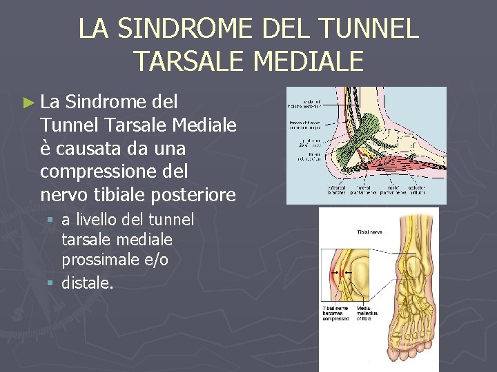 LA SINDROME DEL TUNNEL TARSALE MEDIALE ► La Sindrome del Tunnel Tarsale Mediale è