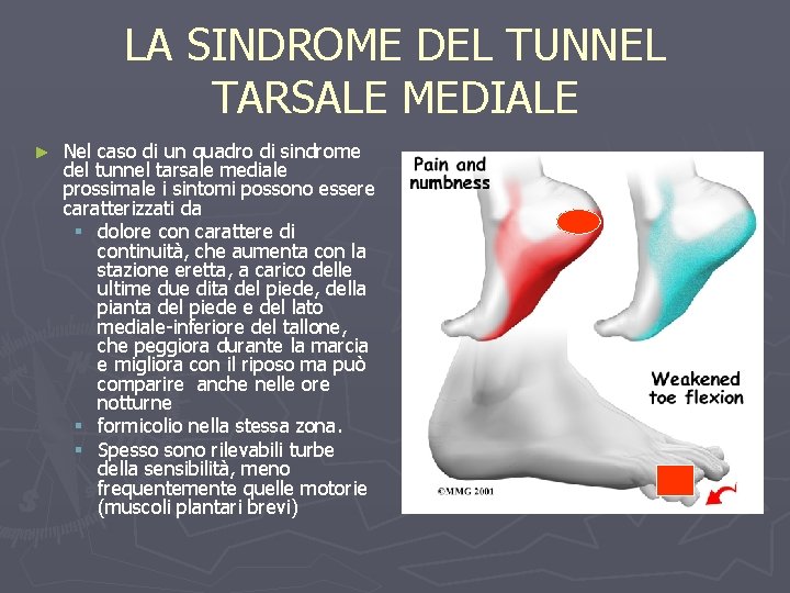 LA SINDROME DEL TUNNEL TARSALE MEDIALE ► Nel caso di un quadro di sindrome