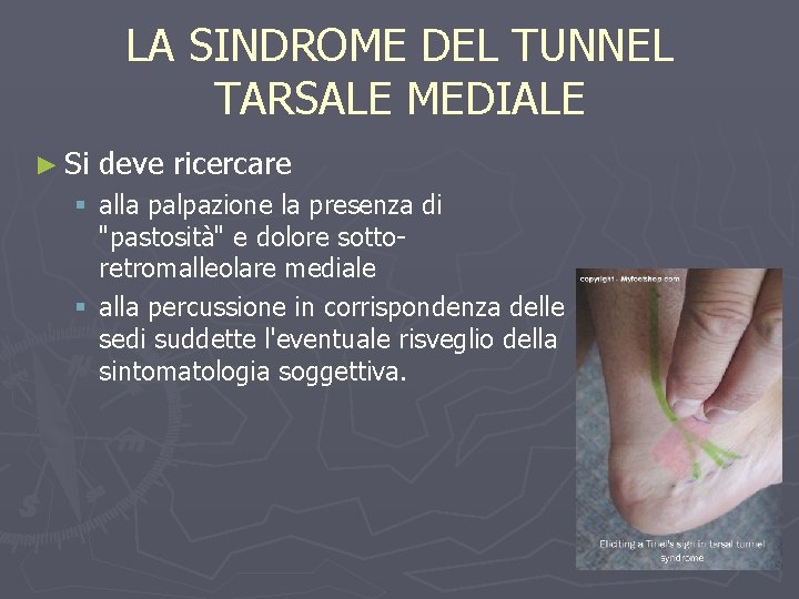 LA SINDROME DEL TUNNEL TARSALE MEDIALE ► Si deve ricercare § alla palpazione la