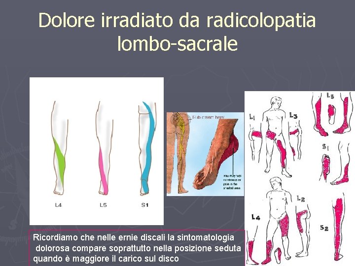 Dolore irradiato da radicolopatia lombo-sacrale Ricordiamo che nelle ernie discali la sintomatologia dolorosa compare