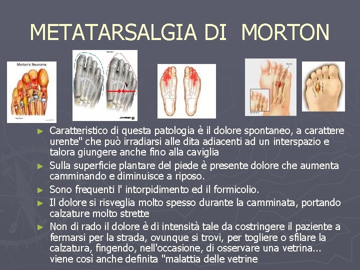 METATARSALGIA DI MORTON ► ► ► Caratteristico di questa patologia è il dolore spontaneo,