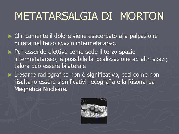 METATARSALGIA DI MORTON Clinicamente il dolore viene esacerbato alla palpazione mirata nel terzo spazio