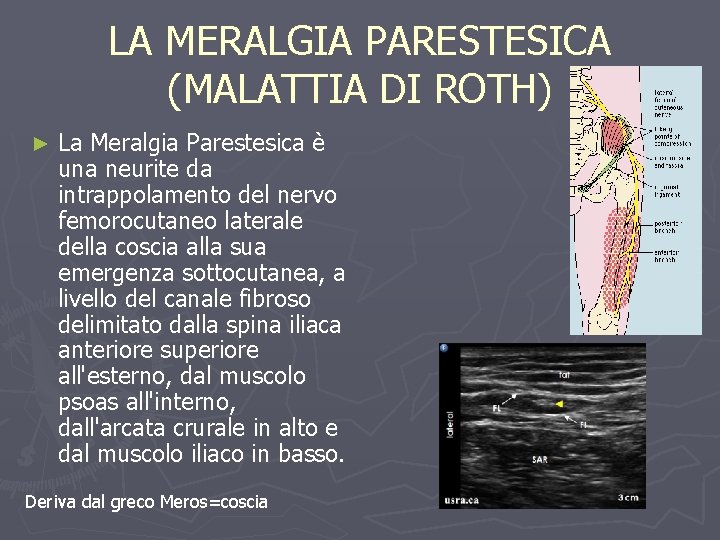 LA MERALGIA PARESTESICA (MALATTIA DI ROTH) ► La Meralgia Parestesica è una neurite da