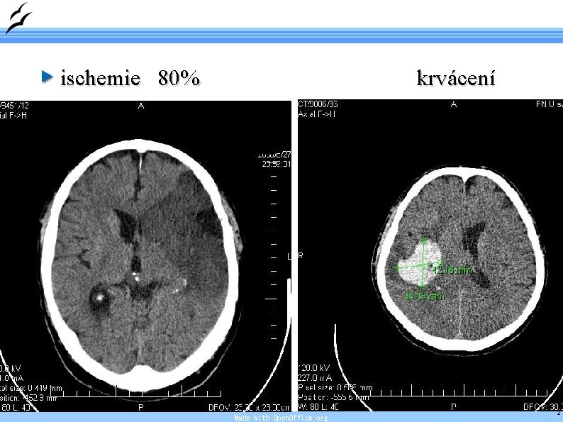 ischemie 80% krvácení Made with Open. Office. org 13 