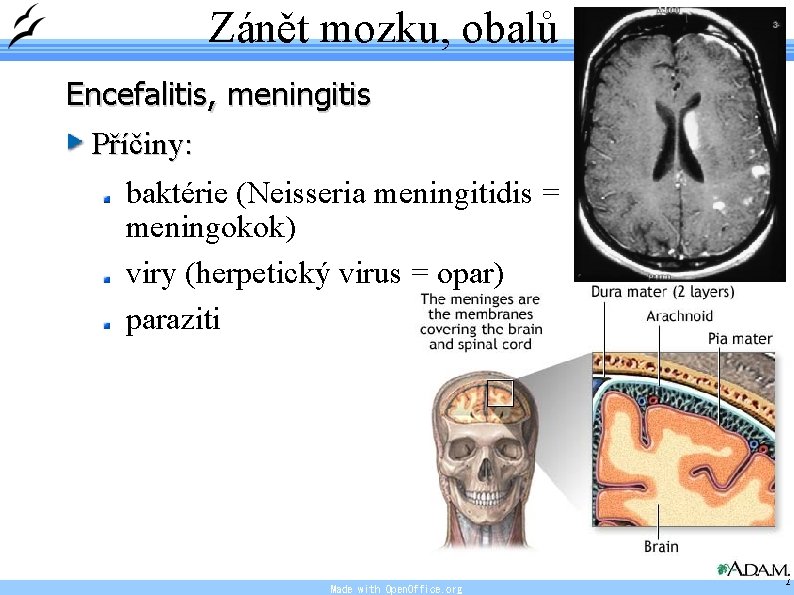 Zánět mozku, obalů Encefalitis, meningitis Příčiny: baktérie (Neisseria meningitidis = meningokok) viry (herpetický virus