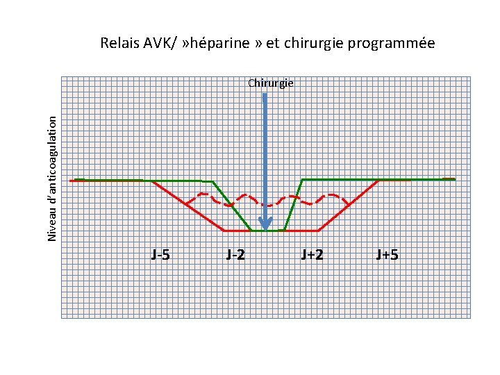 Relais AVK/ » héparine » et chirurgie programmée Niveau d’anticoagulation Chirurgie J-5 J-2 J+5