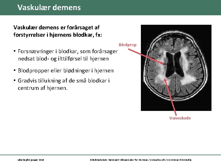 Vaskulær demens er forårsaget af forstyrrelser i hjernens blodkar, fx: Blodprop • Forsnævringer i