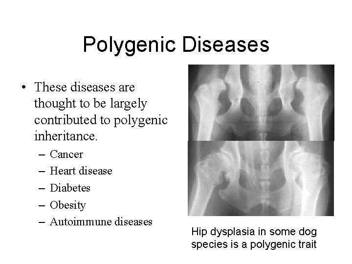 Polygenic Diseases • These diseases are thought to be largely contributed to polygenic inheritance.