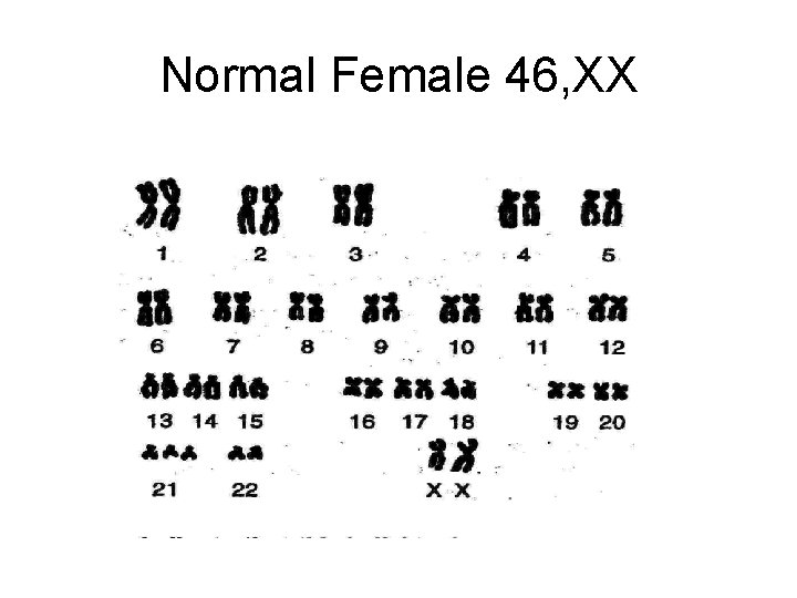 Normal Female 46, XX 