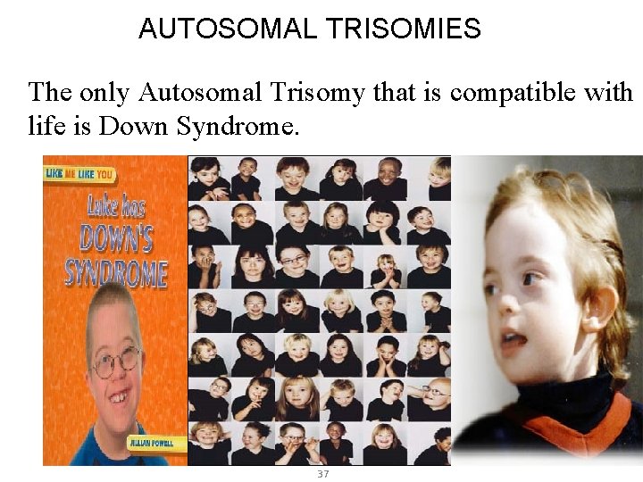 AUTOSOMAL TRISOMIES The only Autosomal Trisomy that is compatible with life is Down Syndrome.