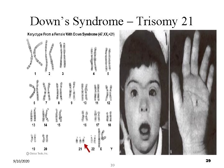 Down’s Syndrome – Trisomy 21 9/10/2020 39 39 