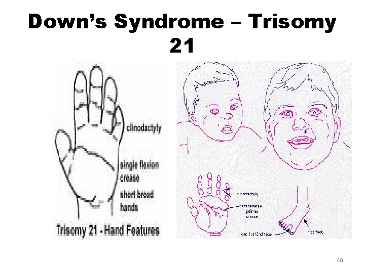 Down’s Syndrome – Trisomy 21 40 