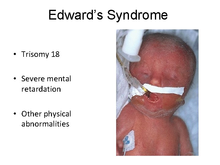 Edward’s Syndrome • Trisomy 18 • Severe mental retardation • Other physical abnormalities 