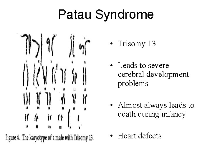 Patau Syndrome • Trisomy 13 • Leads to severe cerebral development problems • Almost