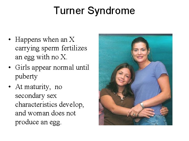 Turner Syndrome • Happens when an X carrying sperm fertilizes an egg with no