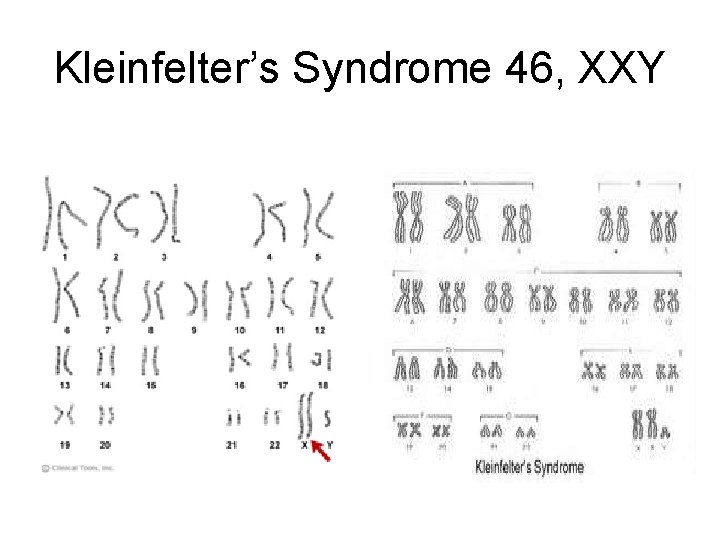 Kleinfelter’s Syndrome 46, XXY 