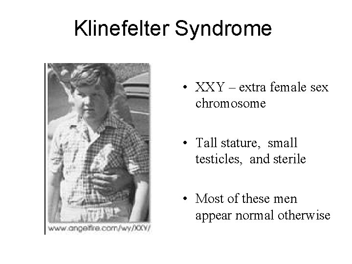 Klinefelter Syndrome • XXY – extra female sex chromosome • Tall stature, small testicles,