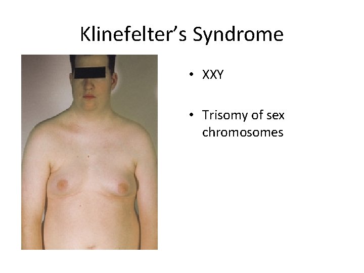 Klinefelter’s Syndrome • XXY • Trisomy of sex chromosomes 