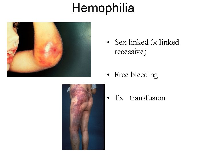 Hemophilia • Sex linked (x linked recessive) • Free bleeding • Tx= transfusion 