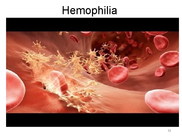 Hemophilia 52 