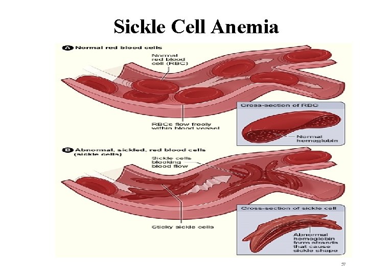 Sickle Cell Anemia 57 