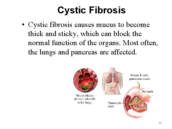 Cystic Fibrosis • Cystic fibrosis causes mucus to become thick and sticky, which can