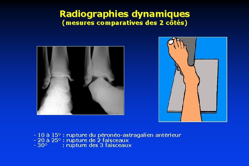 Radiographies dynamiques (mesures comparatives des 2 côtés) - 10 à 15° : rupture du Radiographies dynamiques (mesures comparatives des 2 côtés) - 10 à 15° : rupture du