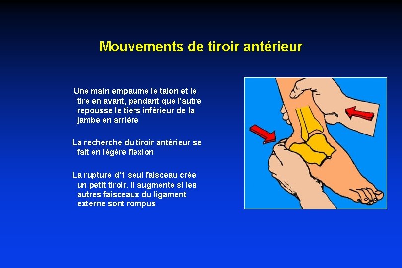 Mouvements de tiroir antérieur Une main empaume le talon et le tire en avant, Mouvements de tiroir antérieur Une main empaume le talon et le tire en avant,