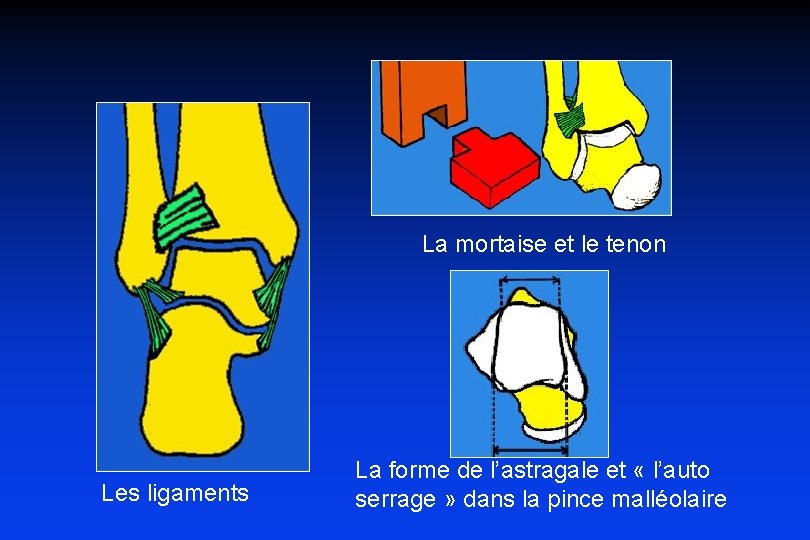 Traumatologie De La Cheville La Mortaise Et Le traumatologie-de-la-cheville-la-mortaise-et-le