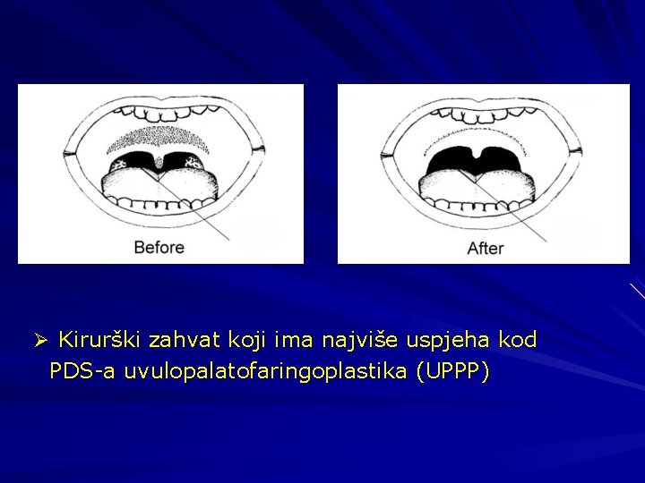 Ø Kirurški zahvat koji ima najviše uspjeha kod PDS-a uvulopalatofaringoplastika (UPPP) 