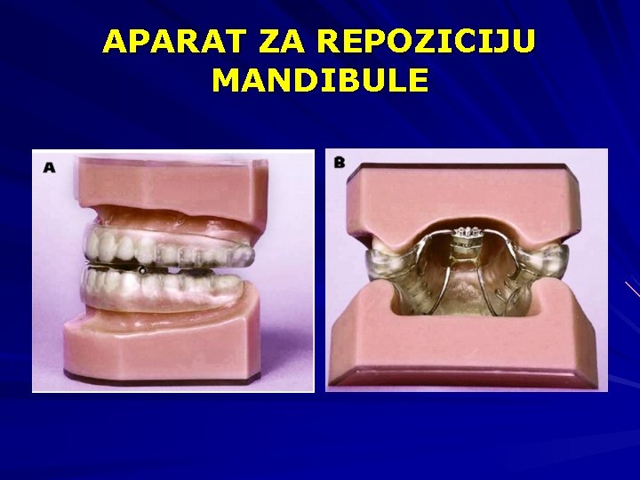 APARAT ZA REPOZICIJU MANDIBULE 