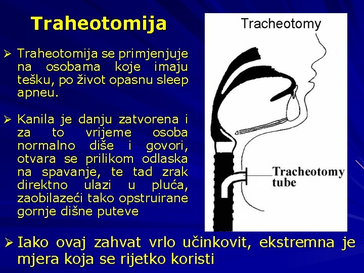 Traheotomija Ø Traheotomija se primjenjuje na osobama koje imaju tešku, po život opasnu sleep