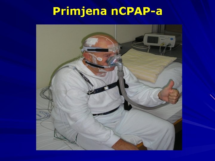 Primjena n. CPAP-a 